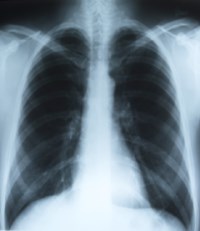 Berylliosis: X-ray clues to lung disease - 2014 - Wiley Analytical Science