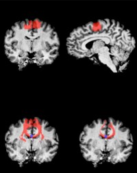 Tackling Tourette syndrome: Therapeutic clues from MRI - 2014 - Wiley ...