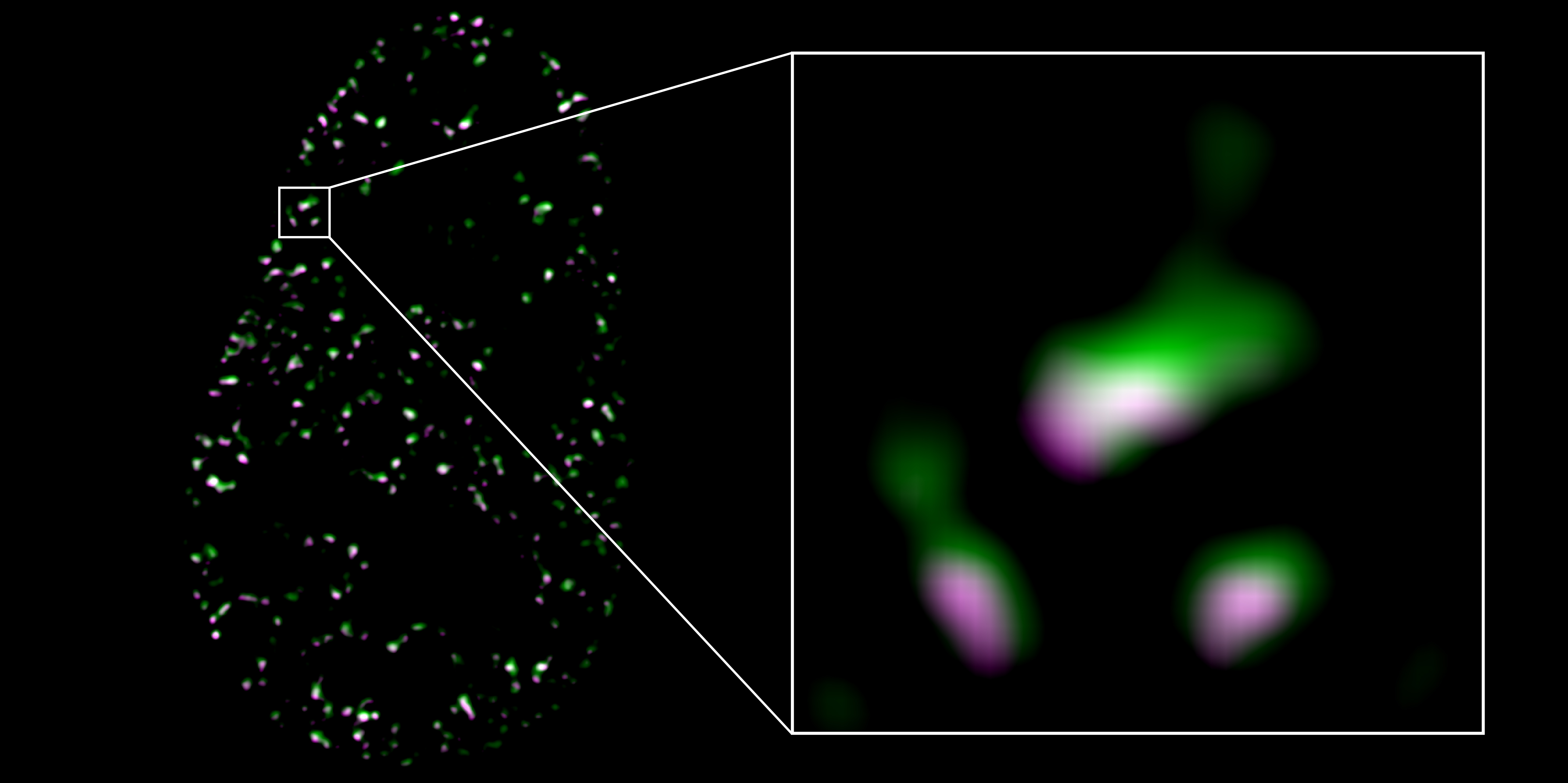 Relationship Between Rare Genetic Disorder And Sex Hormones Uncovered By High Resolution 3d Sim 8977